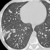 Axial NECT of a 20-year-old man with cystic fibrosis shows multifocal bronchiectasis
, bronchial wall thickening, and soft tissue tubular opacities that correspond to impacted mucus
within dilated peripheral airways.