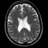 Axial T2WI FS MR demonstrates ovoid hyperintensity along the CSTs bilaterally
. Atrophy and hyperintense foci is due to myelin loss and gliosis. There is frequently involvement of prefrontal motor neurons that play a role in planning or orchestrating the work of the upper and lower motor neurons.