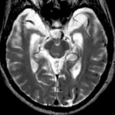 Axial T2WI MR through the inferior temporal lobes shows marked atrophy of the temporal lobes and enlargement of the parahippocampal fissures. (Courtesy J. Norfray, MD.)