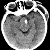 Axial NECT shows large atypical tuber cinereum hamartoma containing a calcification
.