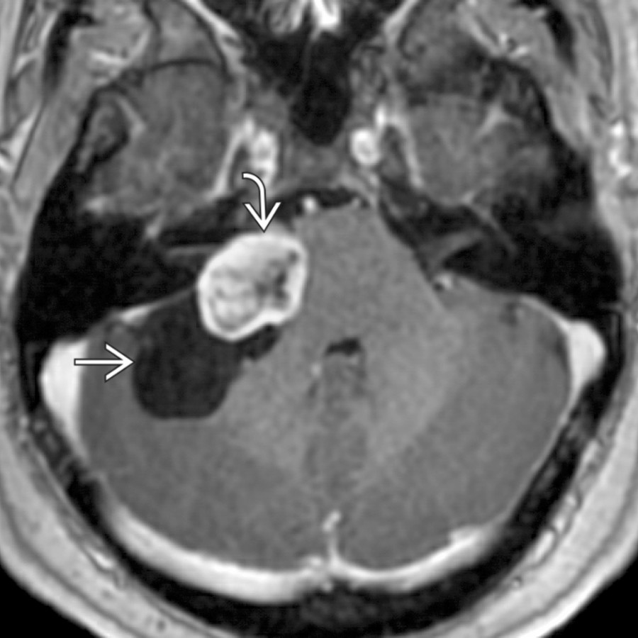 Axial T1 C+ MR shows an atypical heterogeneously enhancing left vestibular schwannoma
with an associated arachnoid cyst
.