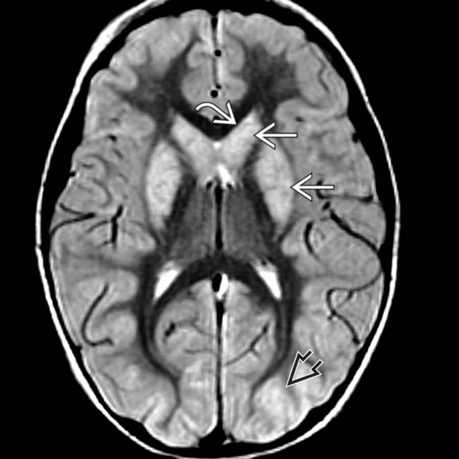 Axial PD FSE MR shows enlarged, bilateral, hyperintense deep nuclei
and small ventricles
from mass effect in hypoxic-ischemic encephalopathy. Cortical hyperintensity is less prominent than on DWI (not shown) except for more advanced bilateral occipital involvement
.