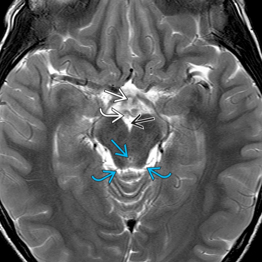 Axial T2 MR at the level of the cerebral aqueduct
demonstrates the infundibular recess of the 3rd ventricle
, mammillary bodies
, interpeduncular cistern
, and the quadrigeminal cisterns
.