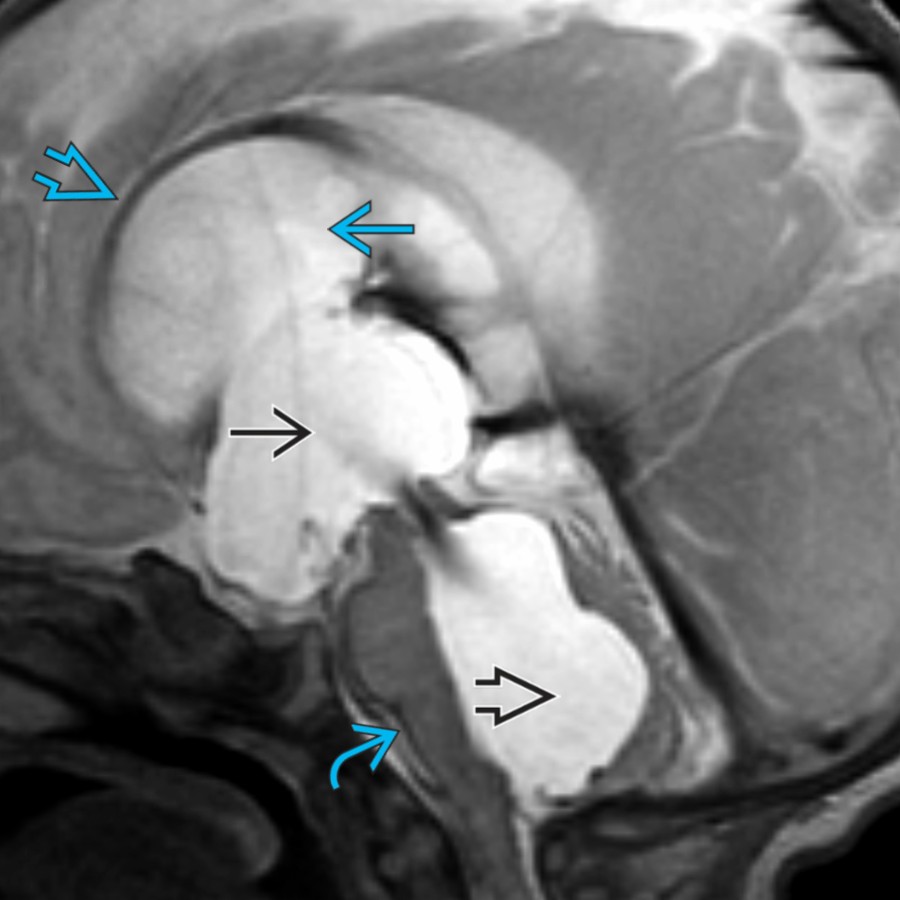 Midline sagittal T2 MR in a neonate with posthemorrhagic hydrocephalus shows a stretched & thinned CC
. Note the enlarged lateral
, 3rd
, & 4th
ventricles as well as thin T2 hypointensity
along the brainstem, consistent with hemosiderin deposition.