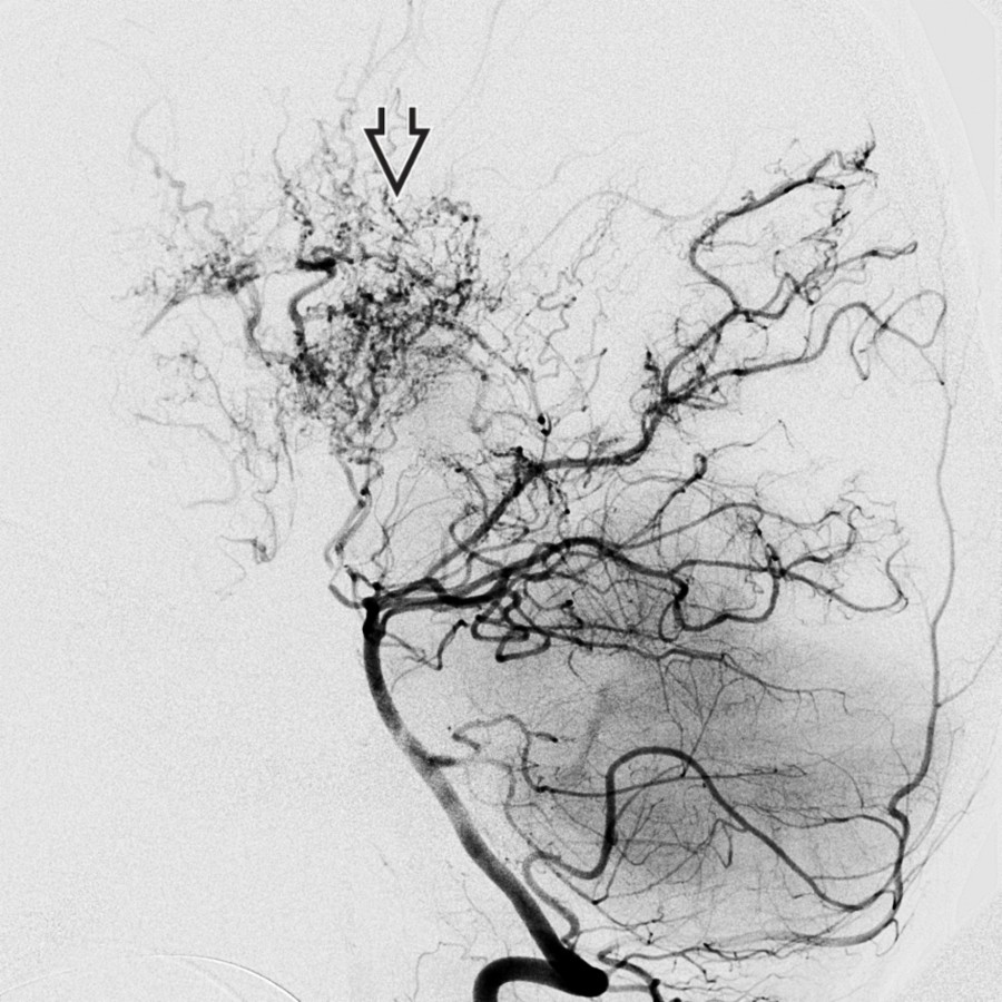 Lateral DSA in the same patient shows the collaterals (moyamoya vessels)
are supplied primarily by thalamoperforating and medial choroidal branches.