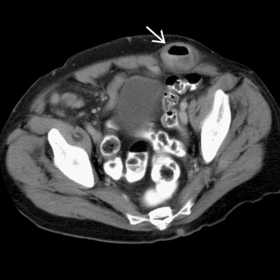 Axial NECT shows a loop of large intestine
herniating lateral to the rectus abdominis muscle, consistent with a Spigelian hernia.