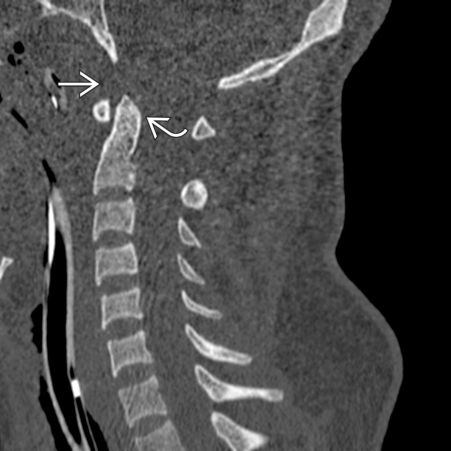 Sagittal CT shows widening of the basion-dental interval
and slight posterior displacement of the odontoid with respect to the foramen magnum
(i.e., abnormal Wackenheim clival line).