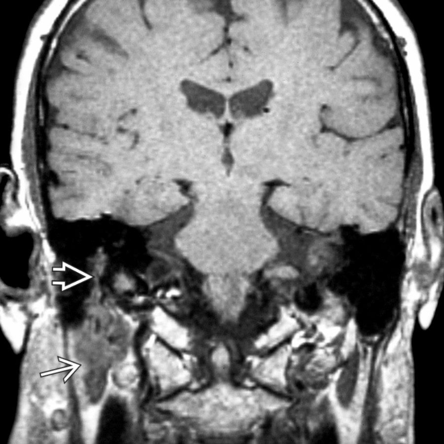 Coronal T1 MR shows invasive parotid space malignancy
with perineural tumor spread cephalad through the stylomastoid foramen to involve the mastoid segment of the facial nerve
.