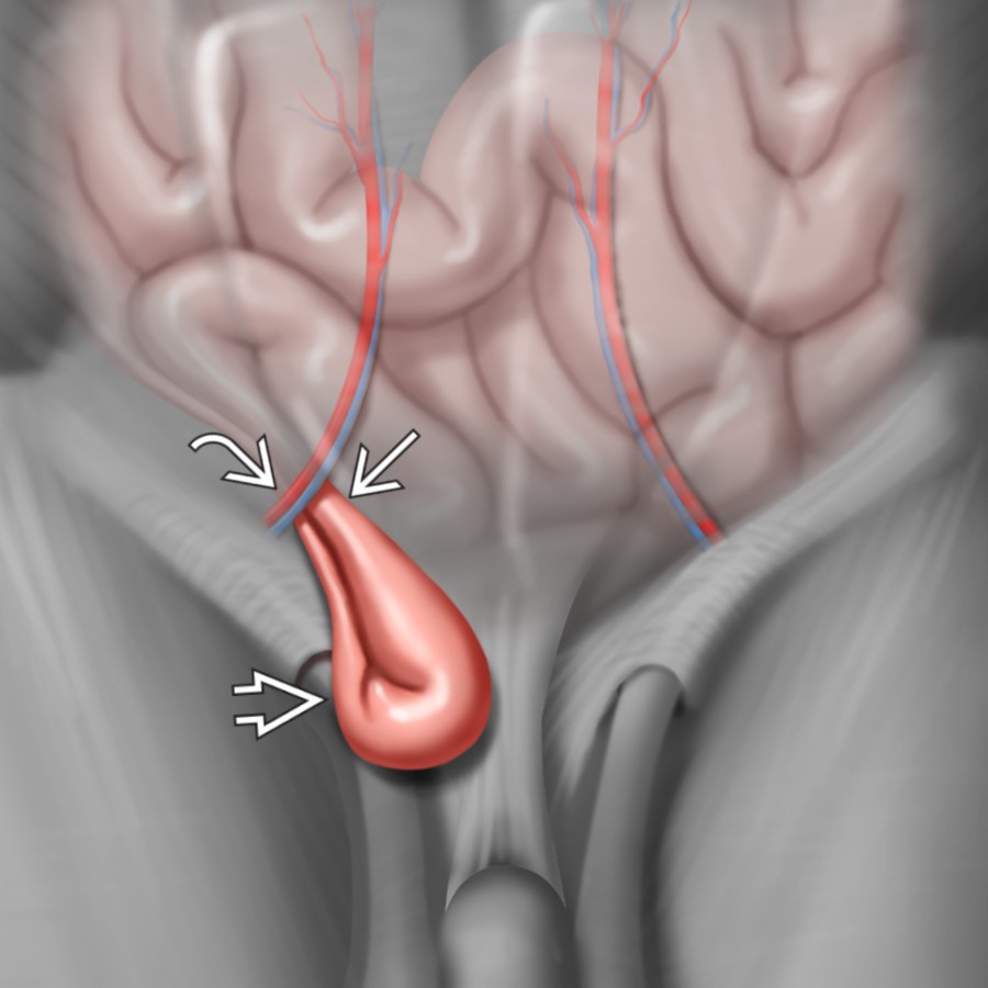 Graphic demonstrates a direct inguinal hernia
with the hernia neck
located medial to the inferior epigastric artery and vein
.