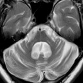 Axial T2WI MR in a SCA3/MJD patient shows pontine midline linear T2-hyperintensity (PMH)
. PMH is also seen in SCA1, DRPLA, & other cerebellar ataxias with brainstem involvement. Bilateral bright MCP
sign is seen; it is also described in SCA2, SCA6, DRPLA, MSA-C, FXTAS, Wilson disease, ischemia, demyelination, etc.
