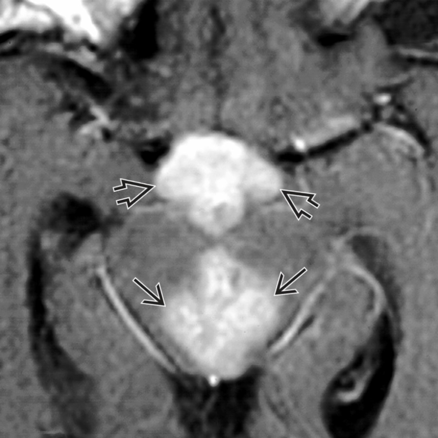 Axial T1 C+ MR shows a lobular enhancing mass in the suprasellar region
and the pineal region
related to germinoma. Germinoma is the most common of the germ cell tumors.