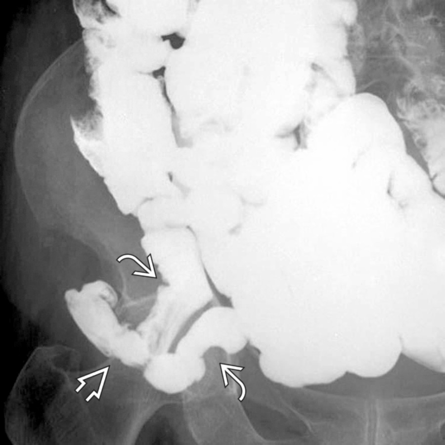 Barium small bowel follow-through study in a patient with a right inguinal hernia shows the herniated small bowel
lying over the right femoral head. Note the constriction of the bowel
as it passes through the inguinal ring.
