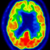 Axial FDG PET in the same patient shows decreased metabolic activity in the left parietal lobe
. Also note mild decreased metabolic activity in bilateral frontal lobes
, indicating possible advanced disease. (Courtesy J. Singh, MD.)