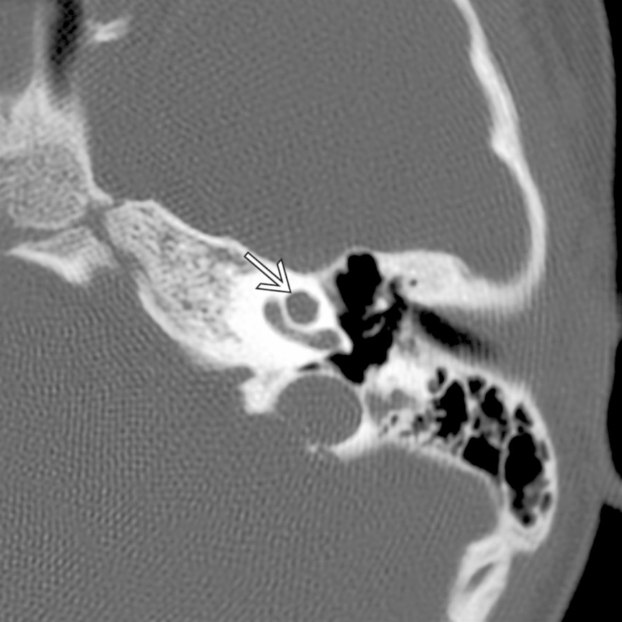 Axial bone CT shows incomplete partitioning of the left cochlea
in a patient with large vestibular aqueduct.