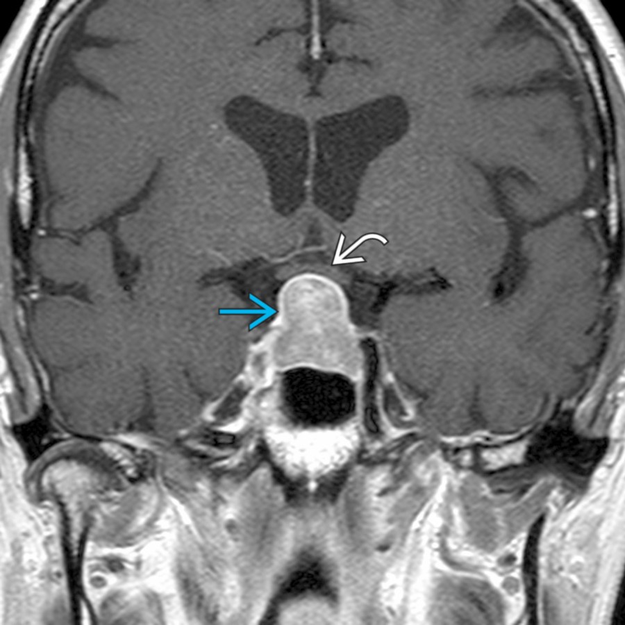 Coronal T1 C+ FS MR shows a large sellar and suprasellar mass
with mild superior displacement of the optic chiasm
. A macroadenoma is the most common suprasellar mass in an adult. In these tumors, a normal pituitary gland cannot be separated from the adenoma.