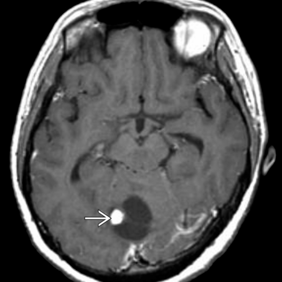 Axial T1 C+ MR in a patient with von Hippel-Lindau syndrome shows a cystic cerebellar mass with a nodule of enhancement
, typical of hemangioblastoma. Retinal angiomas and an additional posterior fossa hemangioblastoma were also present (not shown).