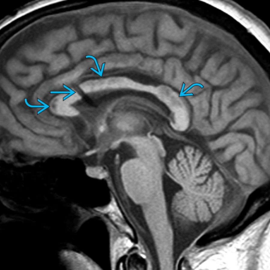 Sagittal T1 MR in the same patient 7 days after placement of the shunt catheter
shows patchy areas of low signal in the CC
. Lateral ventricles are now decompressed, and there is no mass effect on the CC.