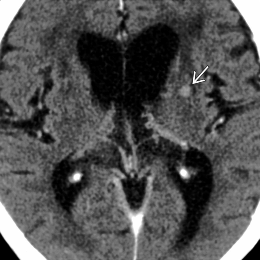 Axial CECT shows a case of paragonimiasis with a hyperdense left BG nodule
. This parasite often presents with conglomerated granulomas, which may hemorrhage. Multiple Ca⁺⁺ are common.