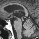 Midline sagittal T1WI in a 67-year-old woman with extrapyramidal symptoms, vertical superior gaze palsy, and gait instability due to progressive supranuclear palsy shows flat surface profile of the cephalad surface of midbrain (hummingbird or penguin sign)
.