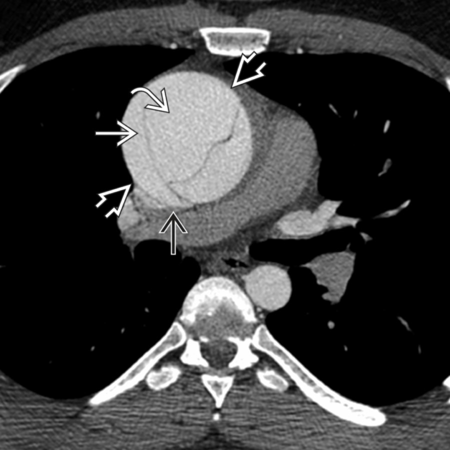 Axial CECT shows ascending aortic false lumen dilation
in acute dissection. Note the "bird beak" sign
and "cob web" sign
, which help identify the false lumen
. This patient had a bicuspid valve and was treated with a modified Bentall procedure.