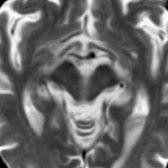 Axial T2 MR in the same patient shows abnormal concavity of the lateral margin of midbrain tegmentum
referred to as the morning glory or Mickey Mouse sign.