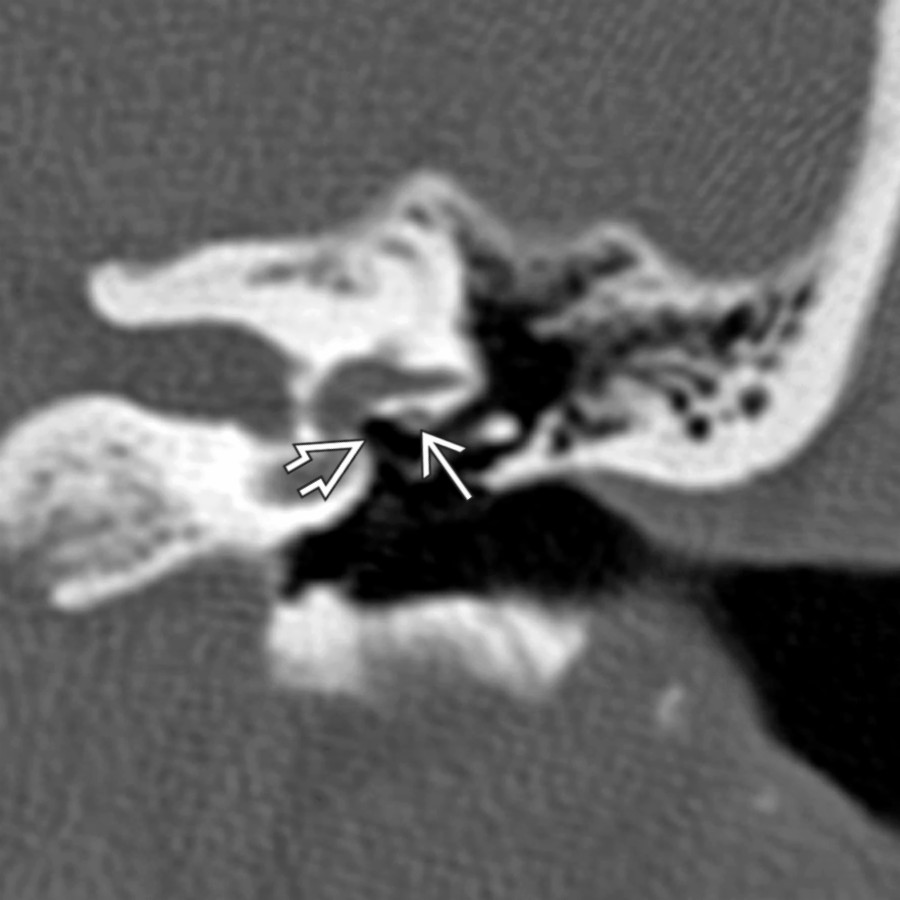 Coronal left ear temporal bone CT shows the normal tympanic segment of the facial nerve in cross section
along the undersurface of the lateral semicircular canal. Note subtle bone covering and relationship to the oval window niche
.
