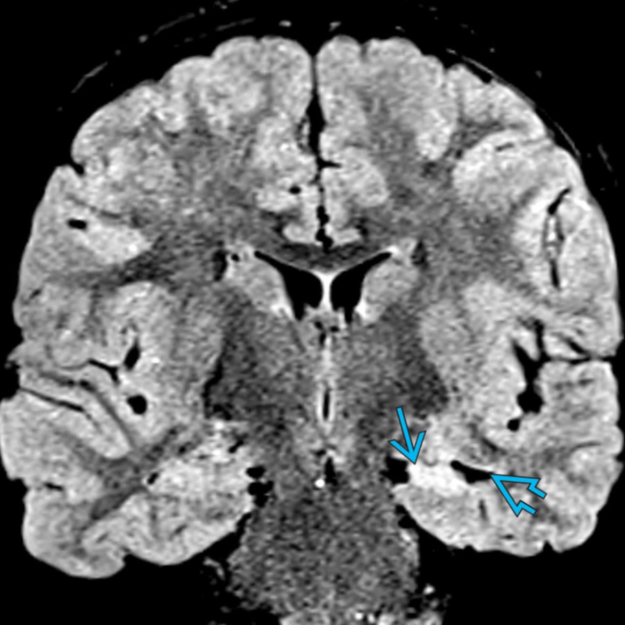 Coronal FLAIR MR shows atrophy and hyperintensity of the left hippocampus
, consistent with left mesial temporal sclerosis. There is also loss of the normal internal architecture of the left hippocampus and ex vacuo dilatation of the left temporal horn
.