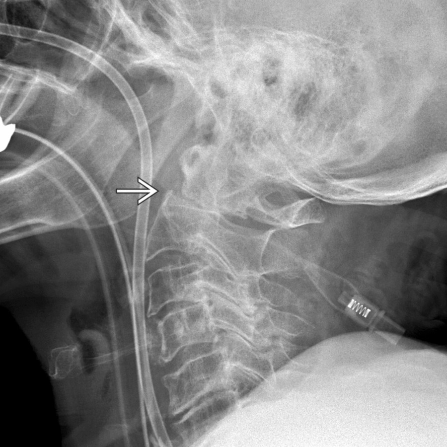 Plain radiograph shows a fracture through the base of the odontoid
, which is displaced posteriorly with slight extension.