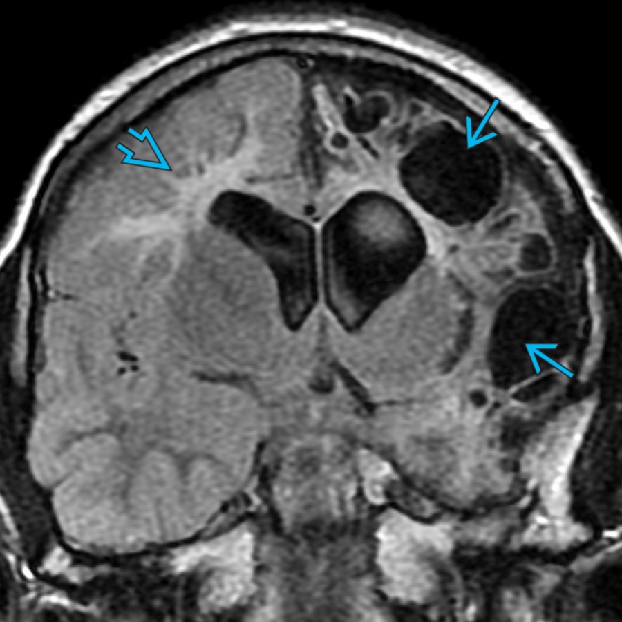 Coronal FLAIR MR in the same patient 7 years later shows development of extensive areas of cystic
& noncystic
encephalomalacia affecting the left > right cerebral hemispheres.