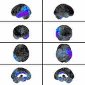 Brain surface rendering of F-18 FDG PET of the brain in a patient with lvPPA demonstrates statistically significant areas of hypometabolism
in the left temporoparietal region relative to an age-matched database.
