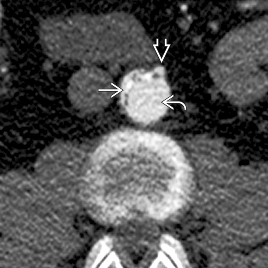 Axial CECT shows a severely displaced dissection flap, compressing the true lumen and occluding the SMA
. Note true lumen
and false lumen
. This was treated with fenestration.