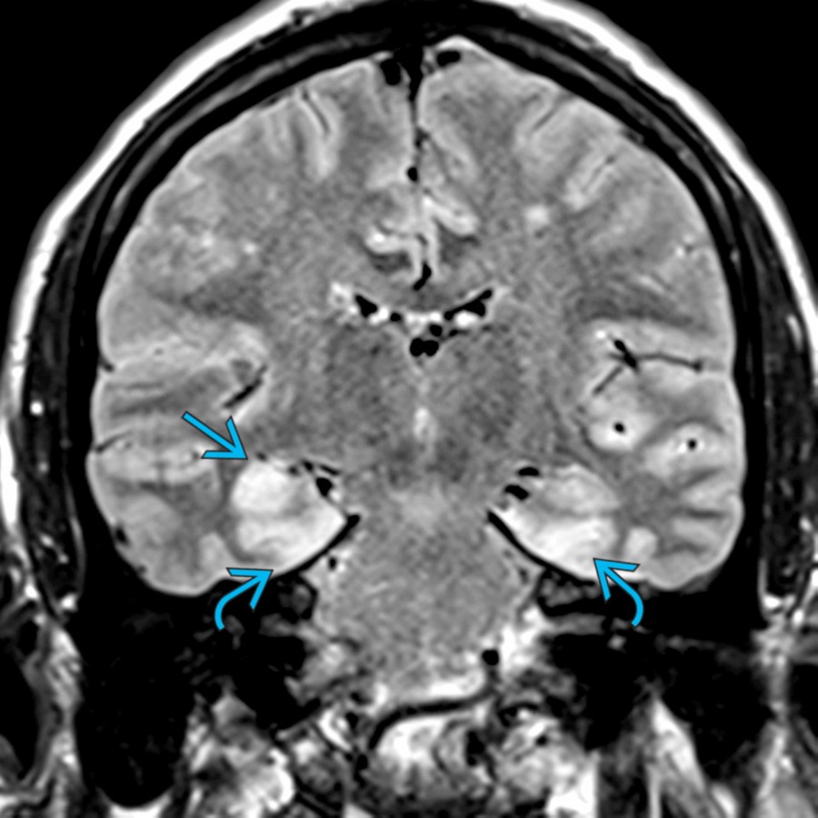 Coronal FLAIR MR shows hyperintensity and swelling of the right hippocampus
and bilateral parahippocampal gyri
. In a patient with acute encephalopathy, seizures, and fever, herpes encephalitis must be excluded.