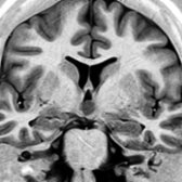 Coronal thin-section IR shows the mass
is actually in the hypothalamus. The mass is clearly isointense with gray matter.