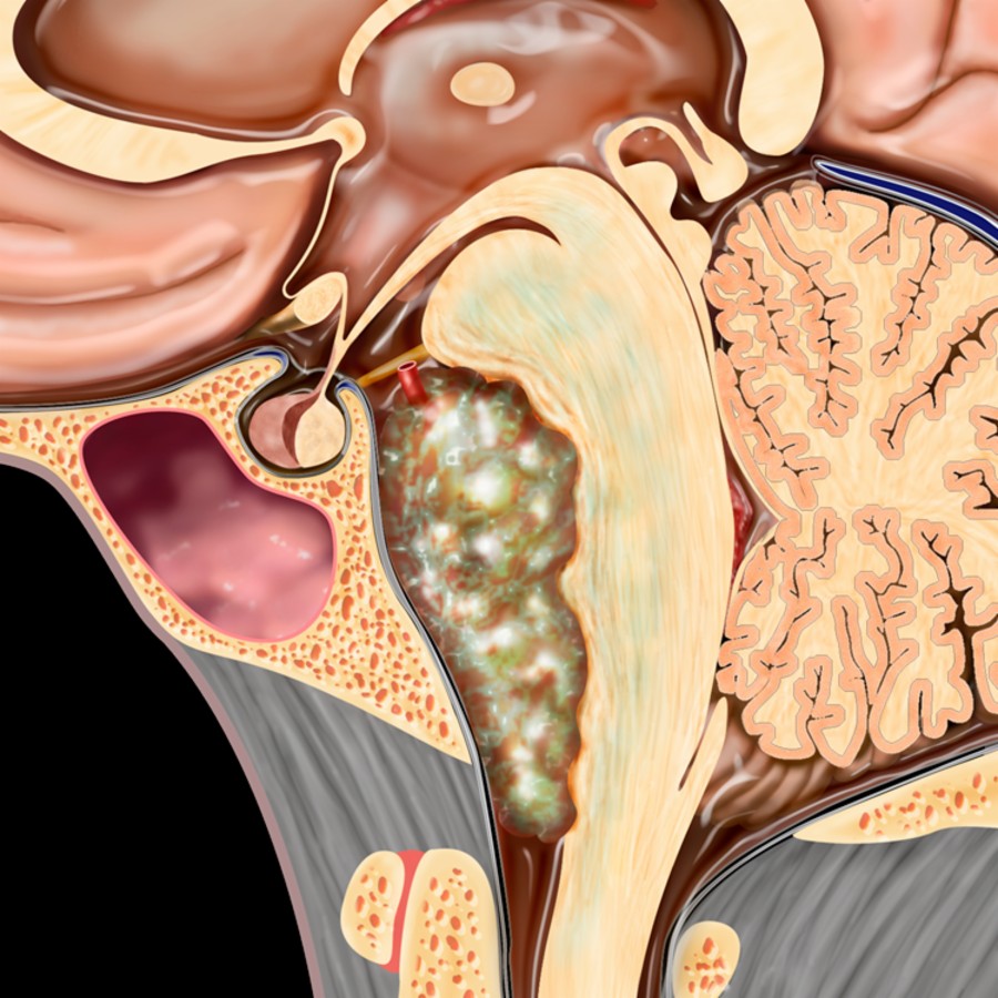 Sagittal graphic shows a multilobulated epidermoid primarily within the prepontine cistern. Significant mass effect displaces the pons, cervicomedullary junction, and upper cervical spine.