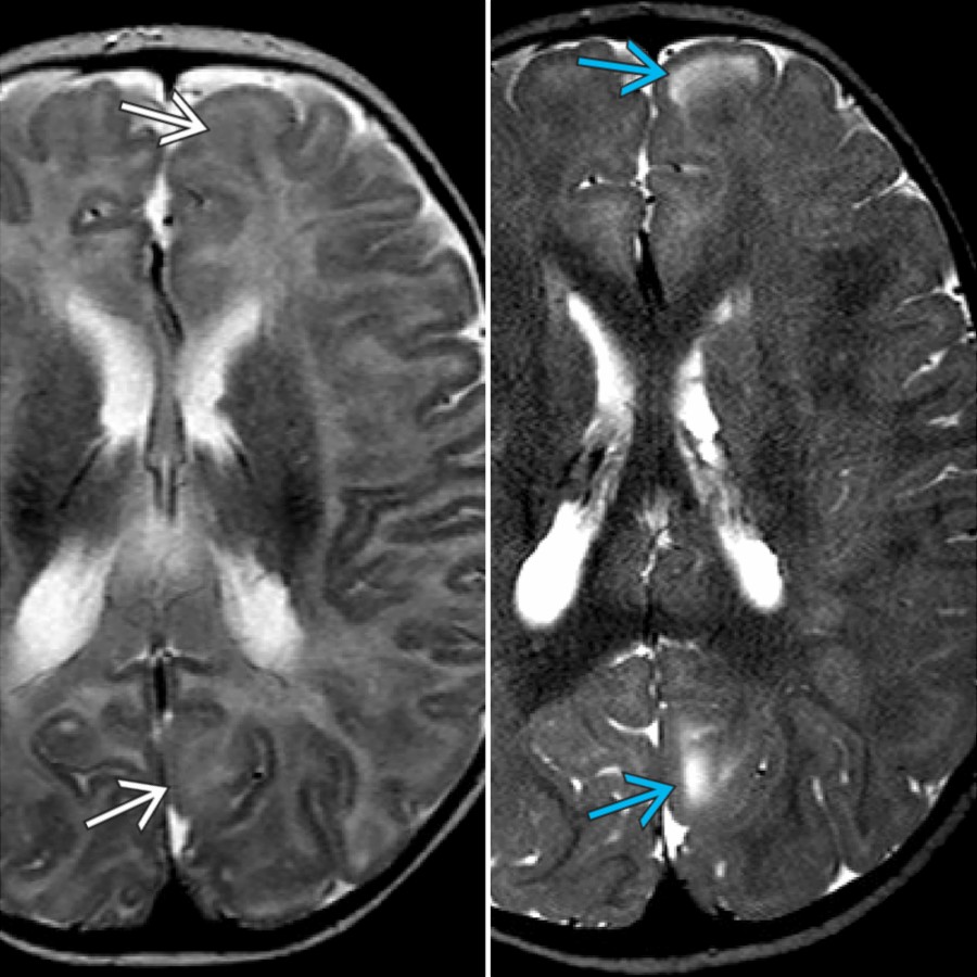 Axial T2 MR in the same patient at 3 months (left) & 10 months (right) of age shows how the cerebral tubers are inconspicuous prior to myelination
(left) but become conspicuous after myelination
(right).