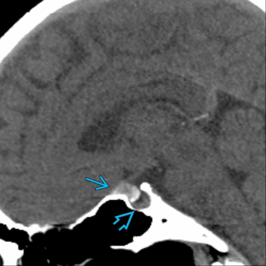 Sagittal NECT shows a partially calcified extraaxial mass projecting from the tuberculum sella
, related to a meningioma. This is separate from the adjacent pituitary gland
within a normal-sized sella turcica. Meningiomas in this location often involve the planum sphenoidale and have a dural tail on contrast-enhanced imaging.