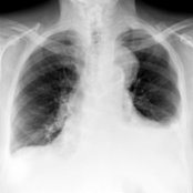 PA chest radiograph in a patient with penetrating aortic ulcer (PAU) of the aortic arch shows a mediastinal mass
lateral to the aortic arch from associated hematoma and a left pleural effusion
. Note the aortic intimal calcification
.