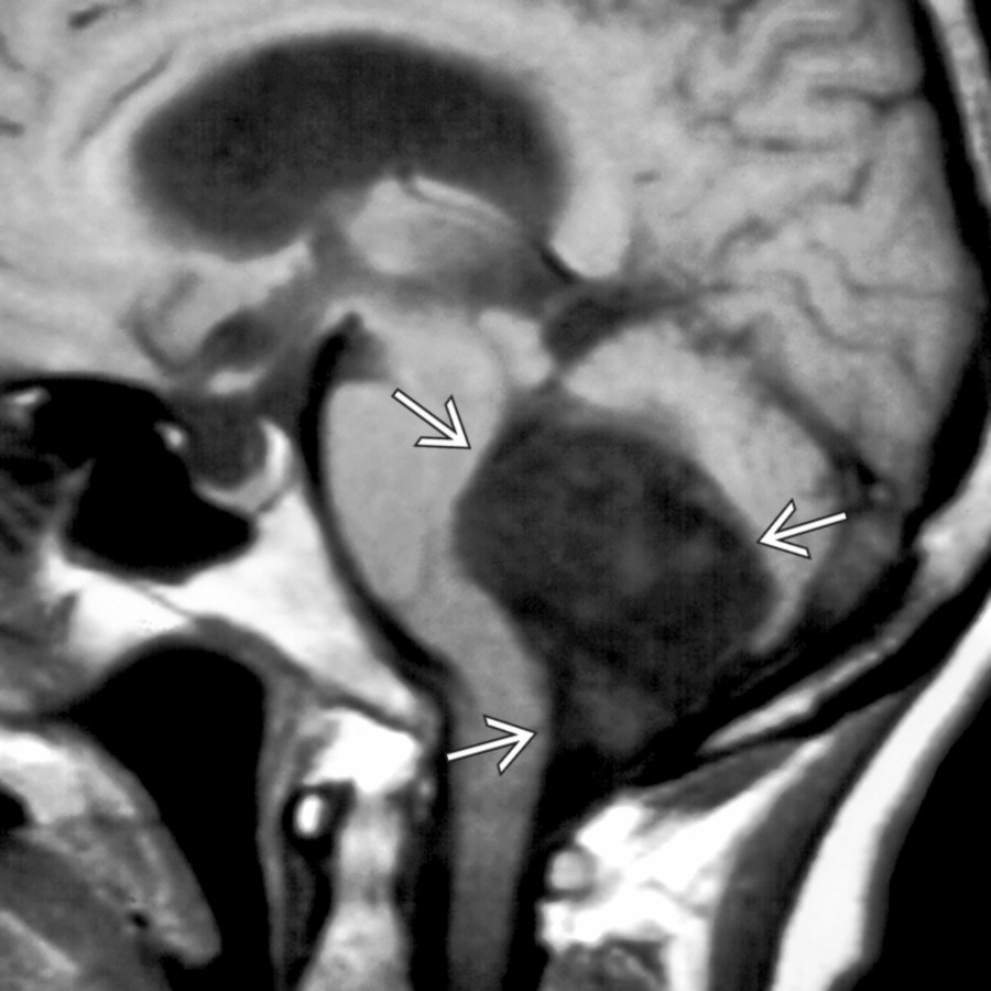 Sagittal T1WI MR shows a typical case of a large 4th ventricular epidermoid cyst
, which follows CSF intensity but is often slightly brighter and mildly heterogeneous in signal.