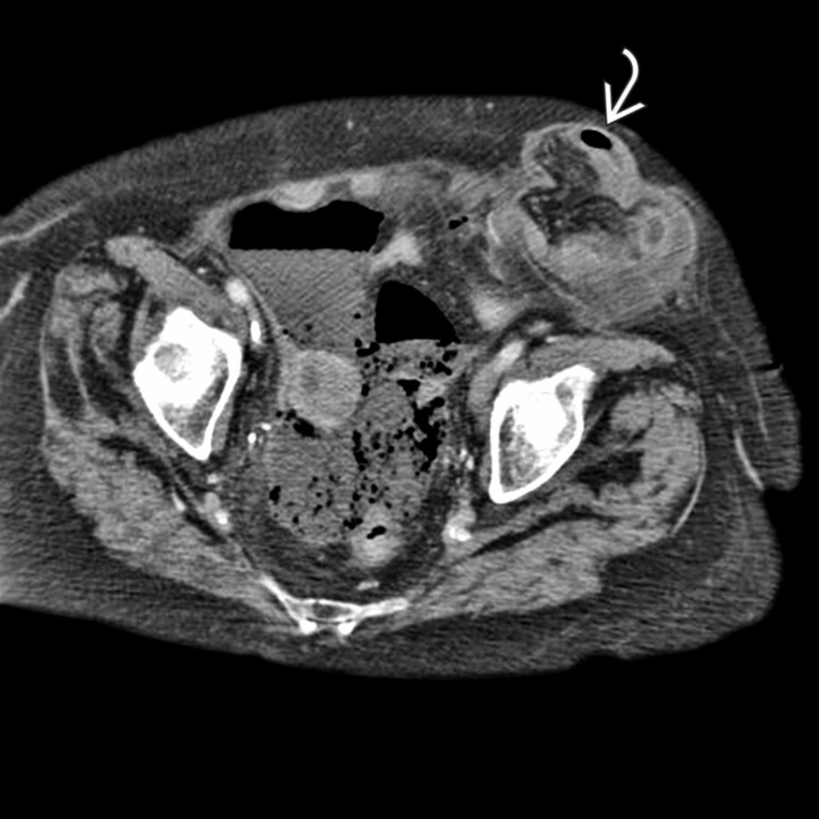 Axial CECT shows a left Spigelian hernia
.