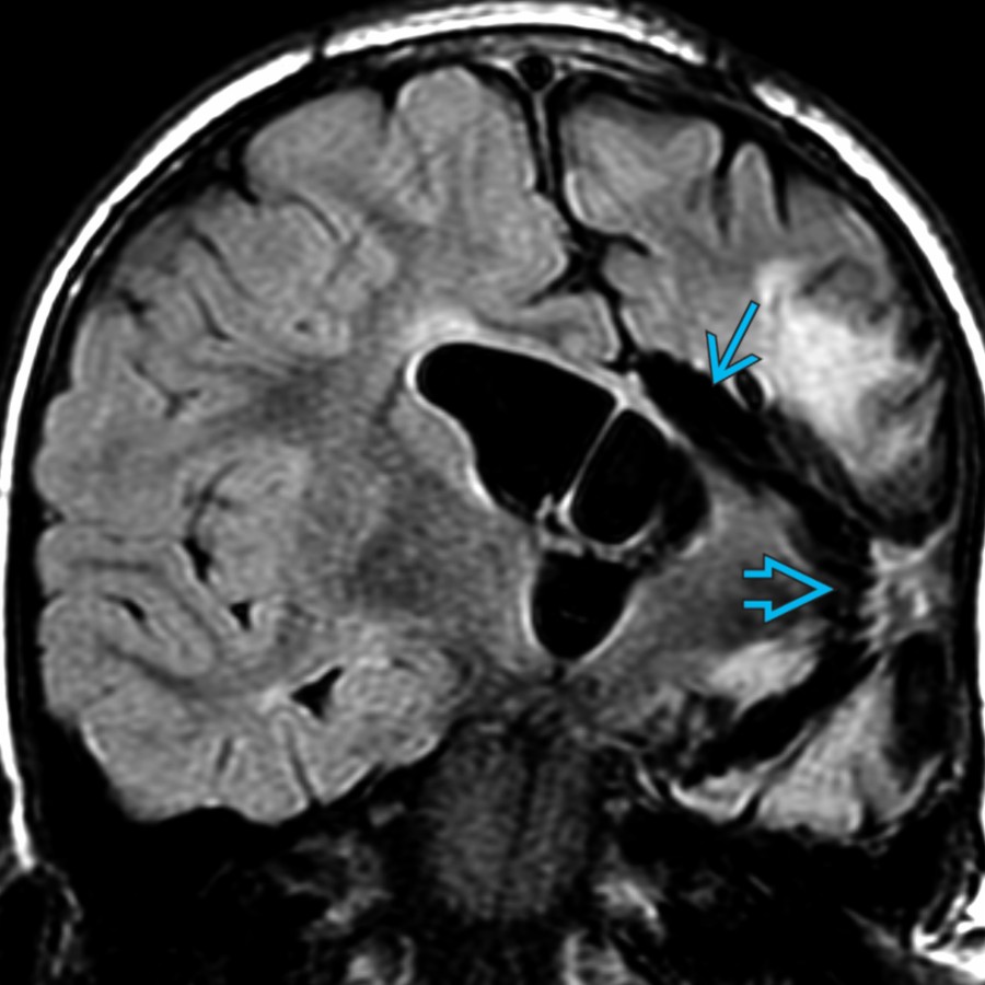 Coronal FLAIR MR shows changes of a left functional hemispherotomy with a WM disconnection
& insular decortication
. Corpus callosotomy may be performed in isolation or as part of a more extensive functional hemispherotomy, as in this patient.