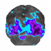Posterior F-18 FDG PET with quantitative mapping shows decreased activity posteriorly (blue/purple), predominantly in the occipital lobe (red outline).