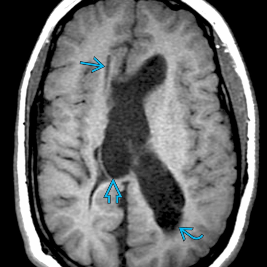 Axial T1 MR demonstrates a right parietal shunt catheter with its tip
in the right frontal horn in a patient with congenital aqueductal stenosis. The right lateral ventricle is collapsed, while the 3rd
and left lateral ventricles
are moderately dilated.