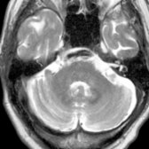 Axial T2WI MR shows an elongated, tortuous basilar artery with a thickened arterial wall
, typical for atherosclerosis-associated fusiform ectasia.
