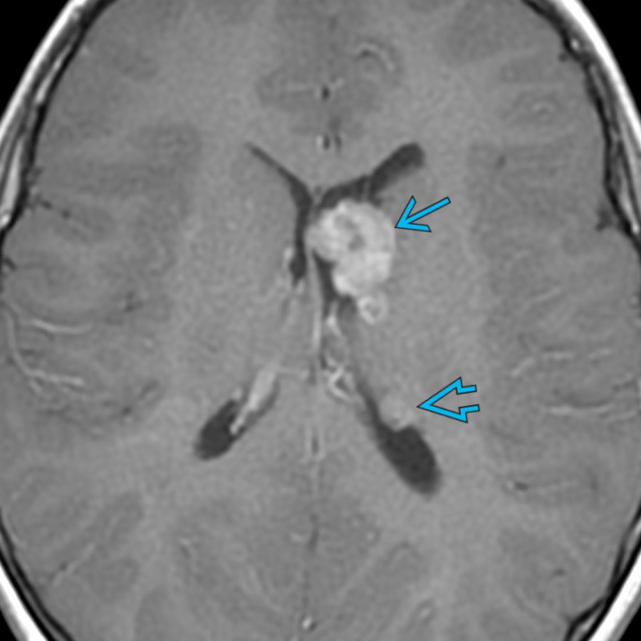 Axial T1 C+ MR in a 9-year-old girl with TSC shows a lobular, homogeneously enhancing mass
in the left caudothalamic groove, consistent with a SEGA. Note the subependymal nodule
.