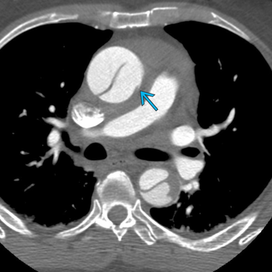 CTA in a 71-year-old man with chest pain shows an aneurysmal ascending aorta with type A dissection. Mediastinal and pericardial hematoma indicate rupture. The only potential rupture site seen on CTA was a slight contour irregularity
, which was confirmed surgically.