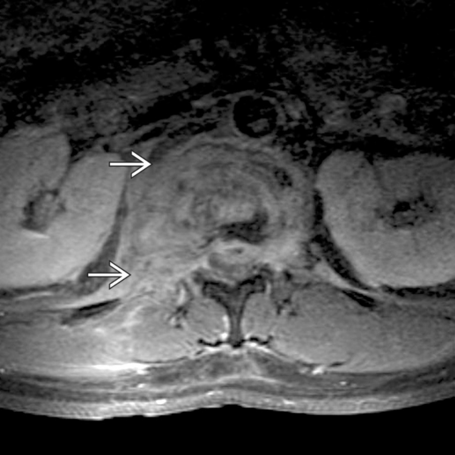 Axial T1 C+ FS MR at the level of the renal hilum shows predominantly right-sided enhancing paraspinal and epidural phlegmon
, associated with discitis and vertebral osteomyelitis. The presence of psoas infection should always prompt careful appraisal of the spine.