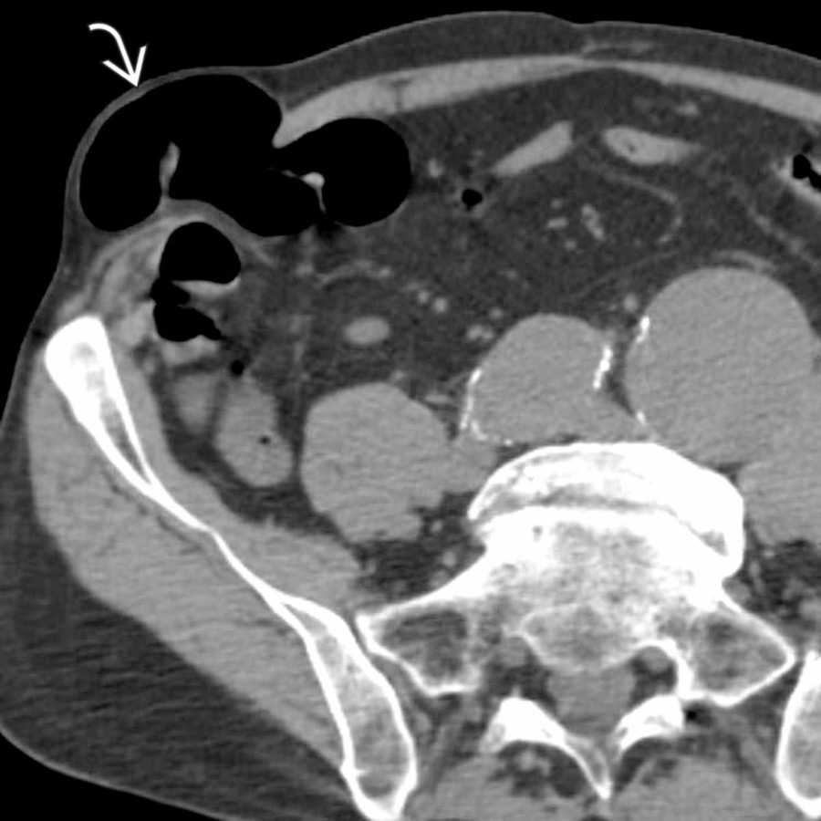 Axial NECT shows aortic and iliac aneurysms and an incidental Spigelian hernia
. The hernia contains a segment of ascending colon, but there is no sign of bowel obstruction.