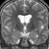 Coronal T2WI MR in the same patient shows the sessile mass
is located in the hypothalamus and remains isointense with gray matter. The mass projects into, but does not obstruct, the 3rd ventricle. Patients with sessile lesions are more likely to present with gelastic seizures.
