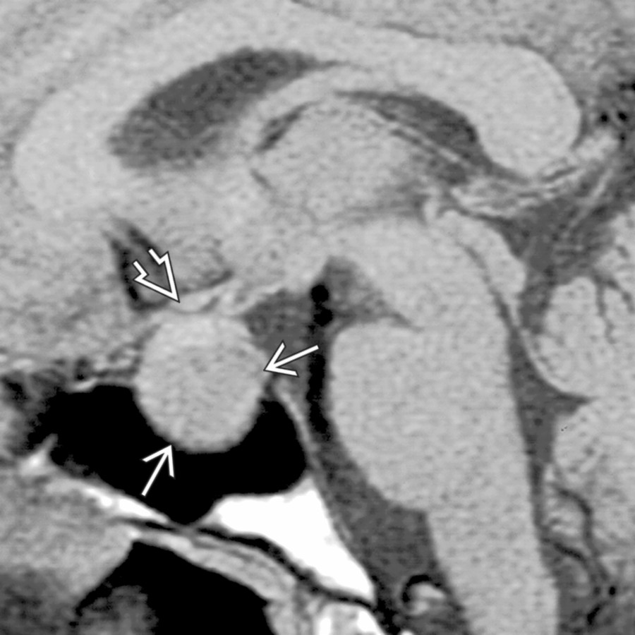 Sagittal T1 MR shows an enlarged pituitary gland
that elevates the optic chiasm
. This enlarged gland is almost isointense with the brain in this example of classic macroadenoma.
