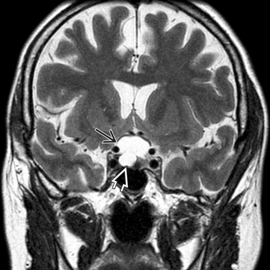 Coronal T2WI MR shows a small AC in the suprasellar cistern that elevates and compresses the optic chiasm. Note both intra-
and suprasellar
components of the cyst.